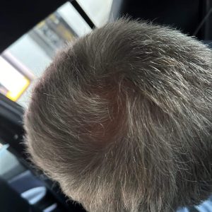 Prf Hårbehandling PBT efter