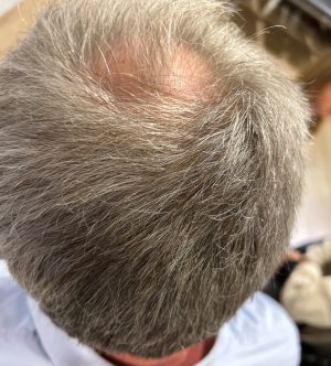 Prf Hårbehandling PBT før