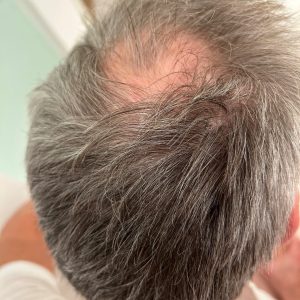 Prf Hårbehandling PBT